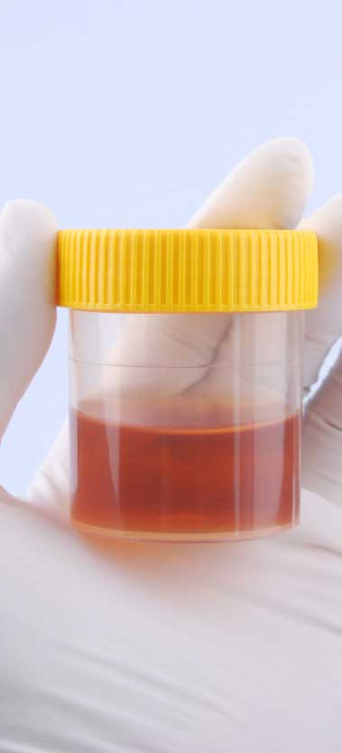 Blood in urine