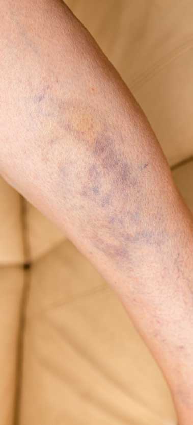 Purple spots (purpura)