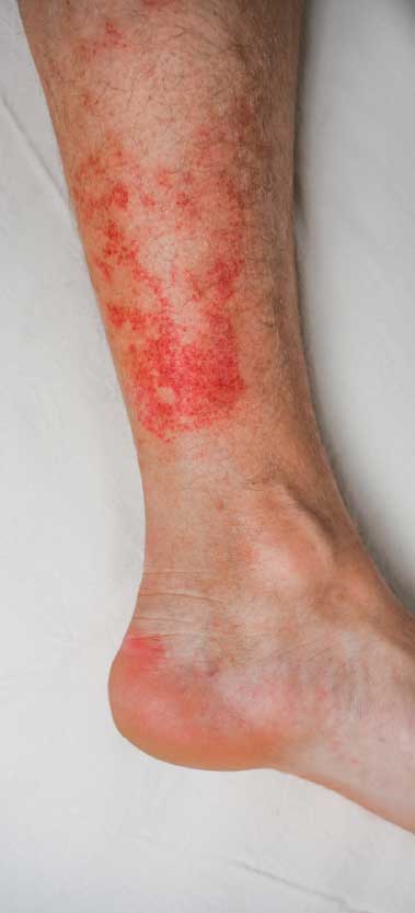 Rashes