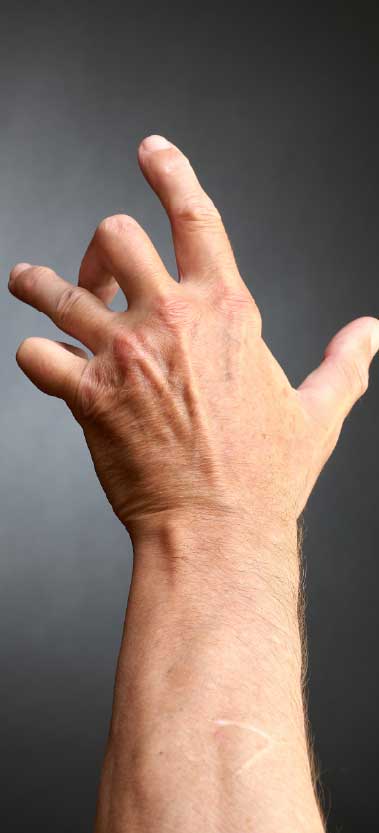 Symmetrical arthritis