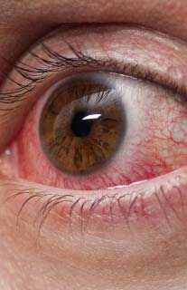 Sjogren Syndrome