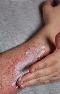 Systemic Lupus Erythematosus