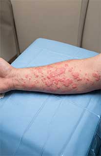 Urticaria