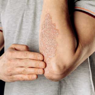 Psoriasis