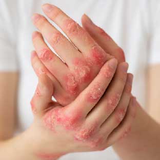 Psoriatic Arthritis