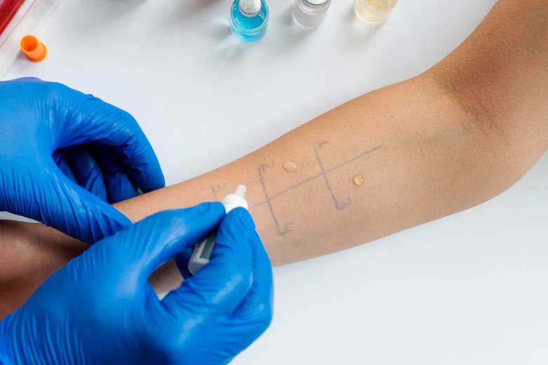 Skin Prick Testing